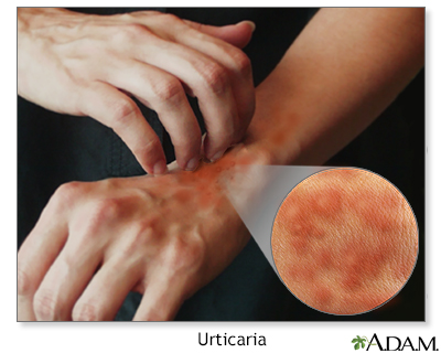 Spanish HIE Multimedia - Urticaria