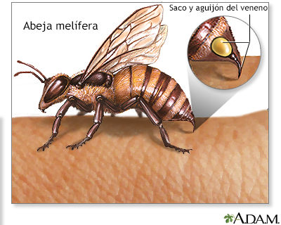 Picaduras de insectos y alergias - Miniatura de ilustración
              