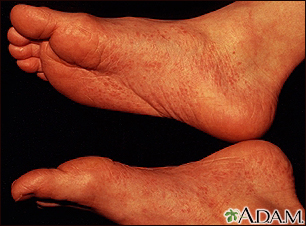 Artritis reactiva - vista del pie