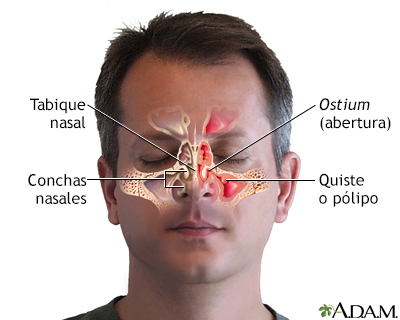 Sinusitis crónica - Miniatura de ilustración
              