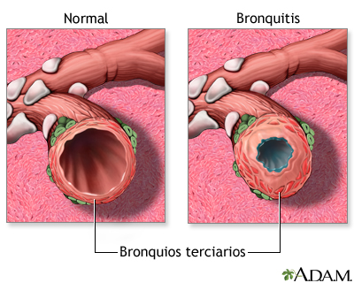Bronquitis y condición normal de los bronquios terciarios - Miniatura de ilustración
              