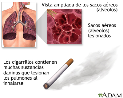 Hábito de fumar y EPOC (enfermedad pulmonar obstructiva crónica) - Miniatura de ilustración
              