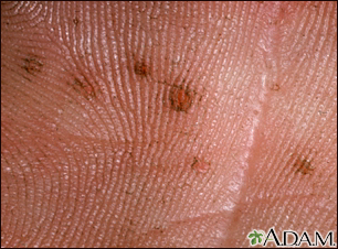 Síndrome de nevo de célula basal - vista de cerca de la palma de la mano - Miniatura de ilustración
              