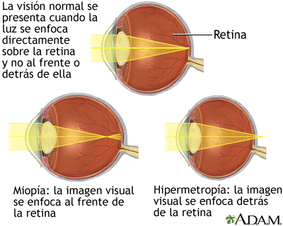 Visión normal, miopía e hipermetropía - Miniatura de ilustración
              