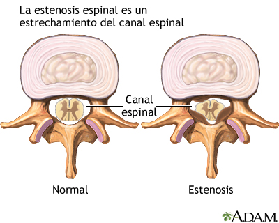 Estenosis espinal