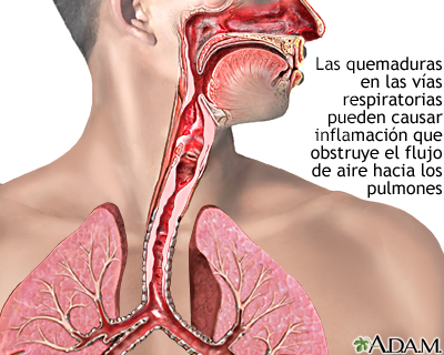 Quemadura de las vías respiratorias - Miniatura de ilustración
              