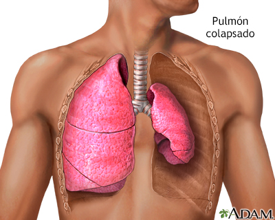 Pulmón colapsado, neumotórax - Miniatura de ilustración
              