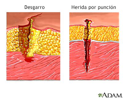 Desgarro versus herida penetrante - Miniatura de ilustración
              