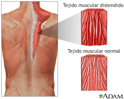 Distensión muscular