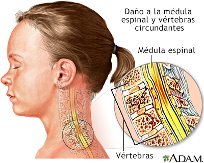 Lesión a la médula espinal - Miniatura de ilustración
              