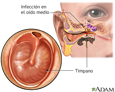 Infección del oído medio