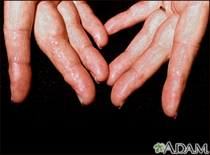 Amiloidosis de los dedos