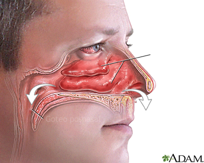 Goteo y congestión nasal - Miniatura de ilustración
              