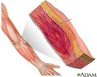 Hematoma muscular - Miniatura de ilustración
              
