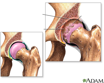 Artritis en la cadera - Miniatura de ilustración
              