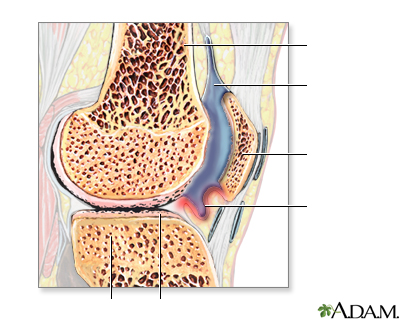 Artritis reumatoidea - Miniatura de ilustración
              