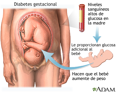 Diabetes gestacional - Miniatura de ilustración
              