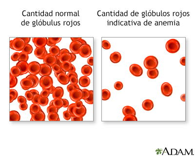 Las células rojas y la anemia