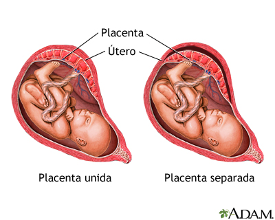 Placenta Abrupta