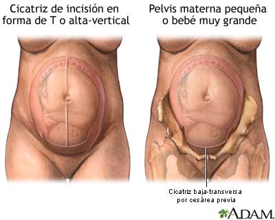 Parto vaginal después de una cesárea (VBAC, por sus siglas en inglés)