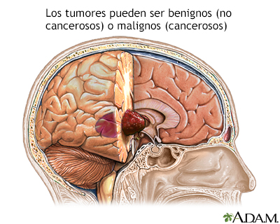Tumor cerebral - Miniatura de ilustración
              