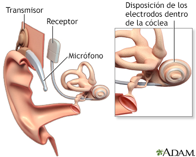 Implante coclear - Miniatura de ilustración
              