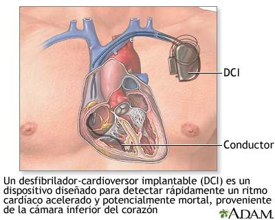 Desfibrilador-cardioversor implantable - Miniatura de ilustración
              