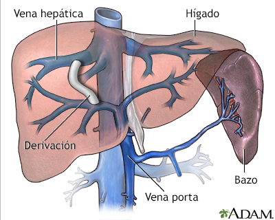 Derivación portosistémica intrahepática transyugular