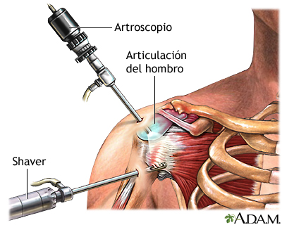 Artroscopia del hombro