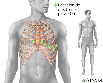 Colocación de electrodos para ECG - Miniatura de ilustración
              