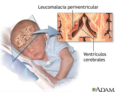 Leucomalacia periventricular - Miniatura de ilustración
              