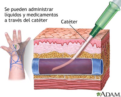 Vía intravenosa periférica - Miniatura de ilustración
              