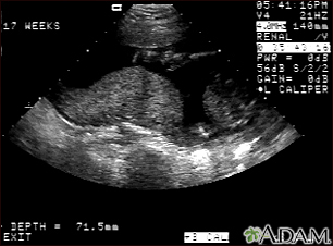 Ultrasonido, placenta normal - Braxton Hicks - Miniatura de ilustración
              
