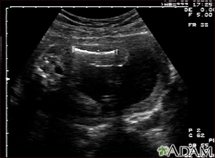 Ultrasonido de un feto normal - medidas del fémur