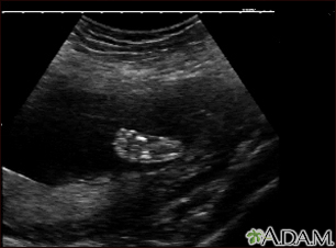 Ultrasonido de un feto normal - pie - Miniatura de ilustración
              