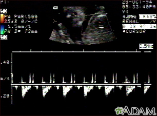 Ultrasonido, normal de los latidos del feto