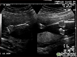 Ultrasonido, normal - brazos y piernas del feto - Miniatura de ilustración
              