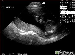 Ultrasonido, normal placenta relajada