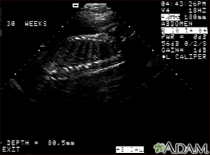 Ultrasonido de un feto normal - columna y costillas - Miniatura de ilustración
              