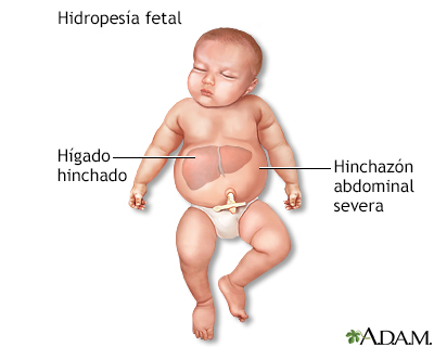 Hidropesía fetal