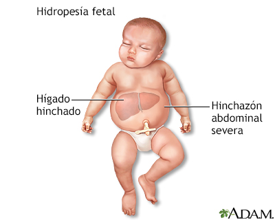 Hidropesía fetal - Miniatura de ilustración
              