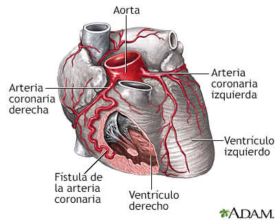 Fístula de la arteria coronaria