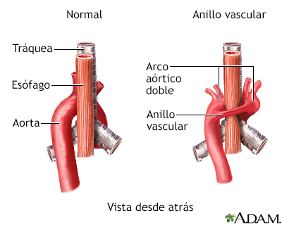 Anillo vascular