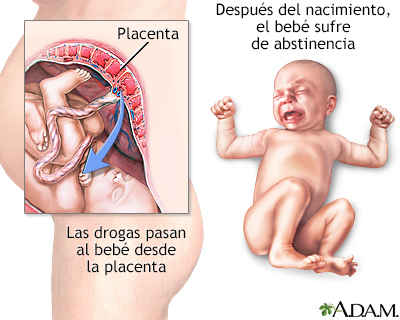 Síndrome de abstinencia neonatal - Miniatura de ilustración
              