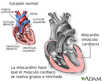 Miocarditis - Miniatura de ilustración
              