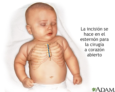 Cirugía a corazón abierto en un bebé - Miniatura de ilustración
              