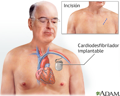 Cardiodesfibrilador implantable - Miniatura de ilustración
              
