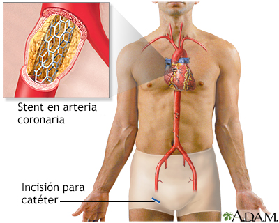 Stent de arteria coronaria - Miniatura de ilustración
              
