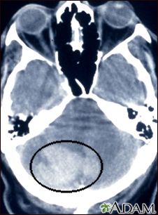 Tomografía computarizada de hemorragia intercerebral