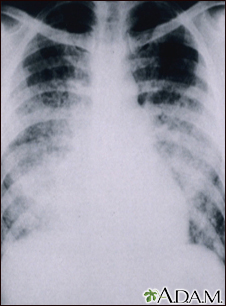 Pulmonía aguda por varicela - Rayos X de tórax - Miniatura de ilustración
              